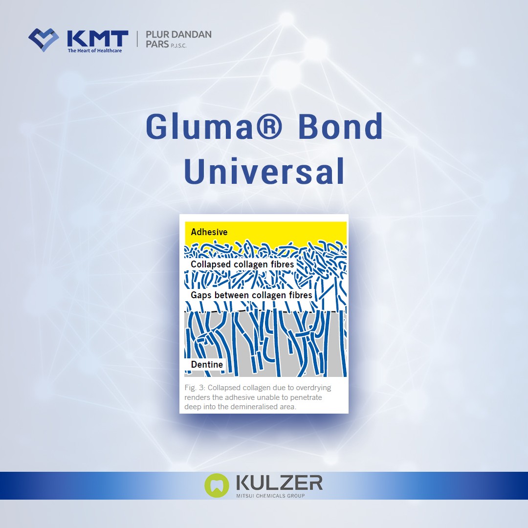 gluma bond universal chart  22