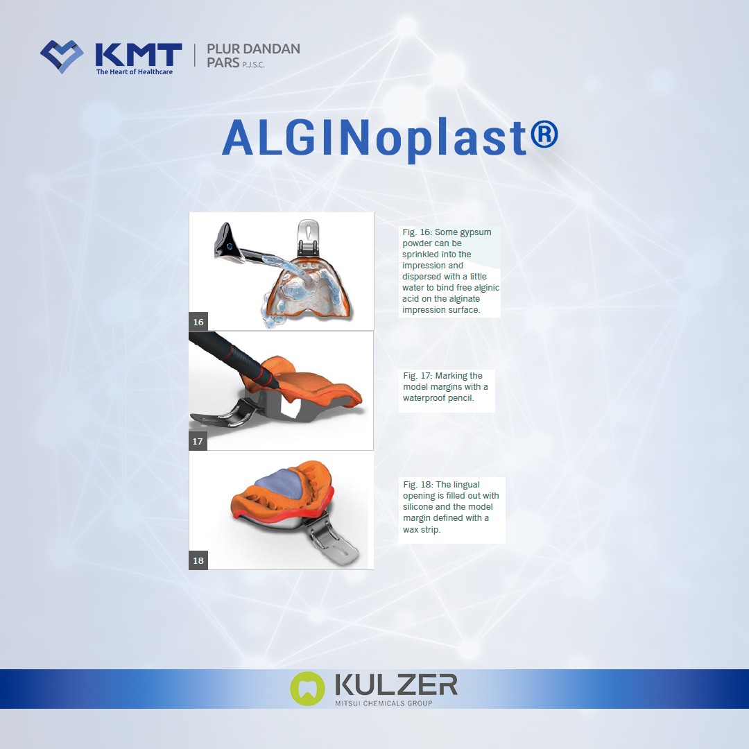 alginoplast chart 12