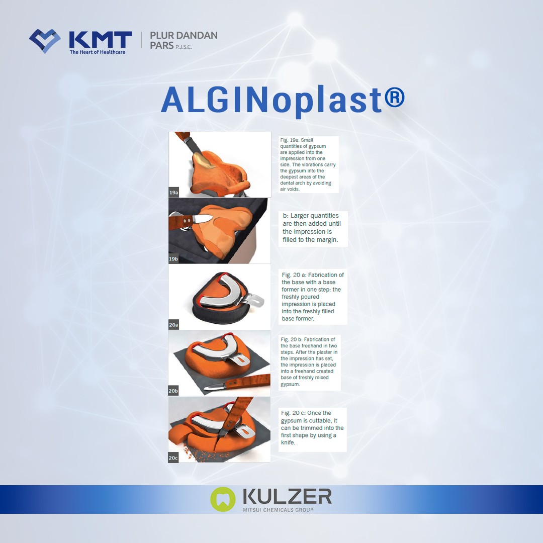 alginoplast chart 13