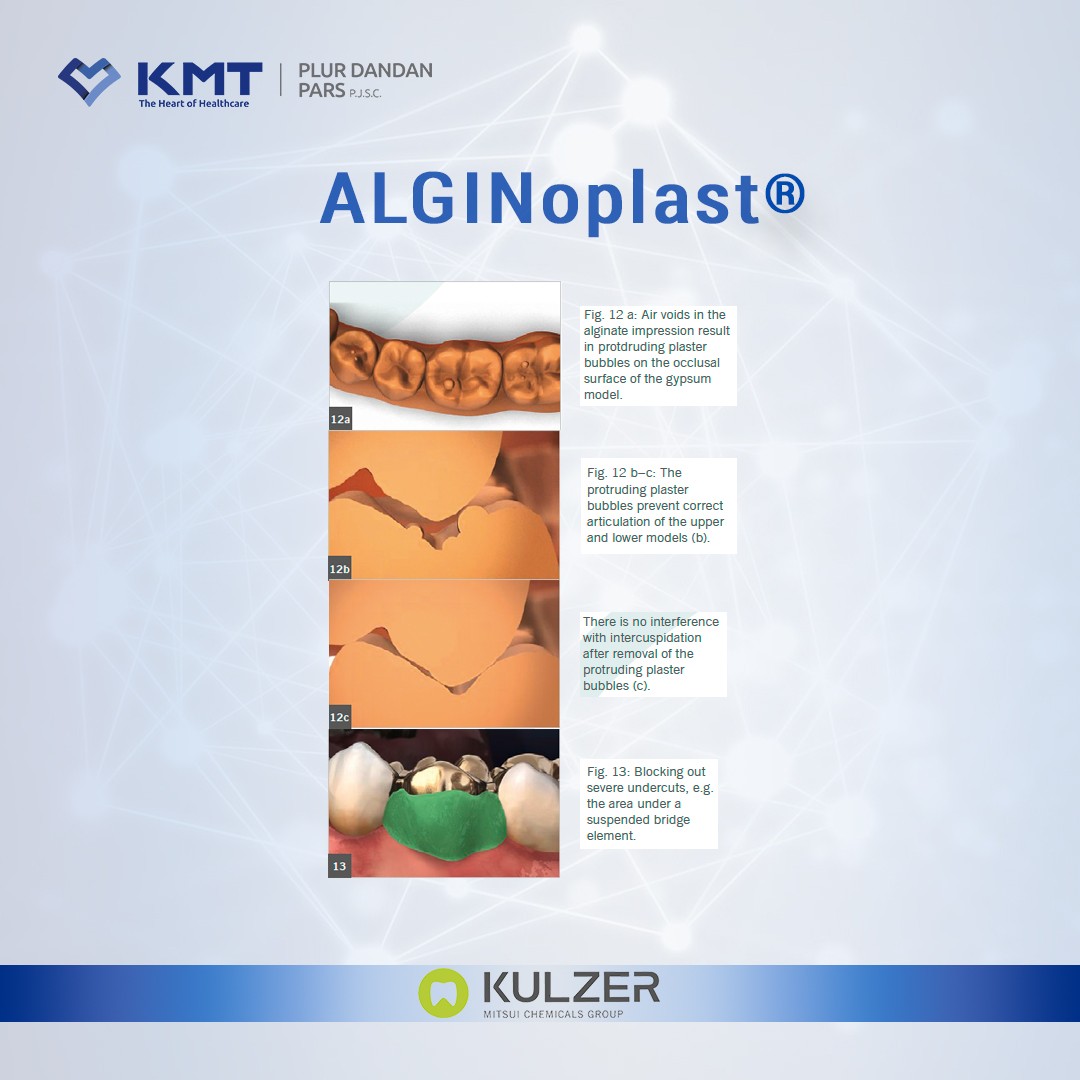 alginoplast chart 10